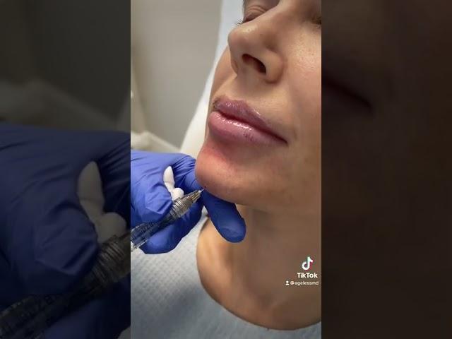 Dermal Filler treatment for smooth out the creases that create shadows around the chin by Ami