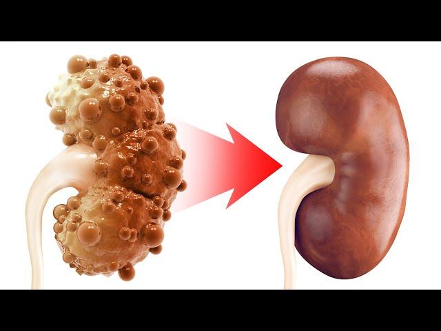 The REAL Cause of Chronic Kidney Disease and Polycystic Kidney Disease