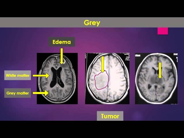 Imaging characteristics of various tissues on T1W MRI