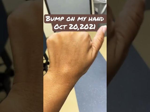 #california #longbeach #bump #in #my #hand #medical #dr #viral #lefthand #weird #amazing #scary