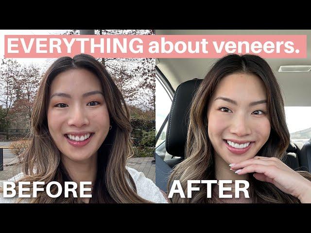 Everything to know about veneers | cost, pain, recovery