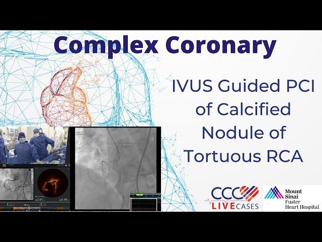 IVUS Guided PCI of Calcified Nodule of Tortuous RCA