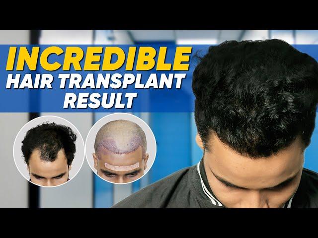 Hair Transplant in Ahmedabad | Best Results & Cost of Hair Transplant in Ahmedabad