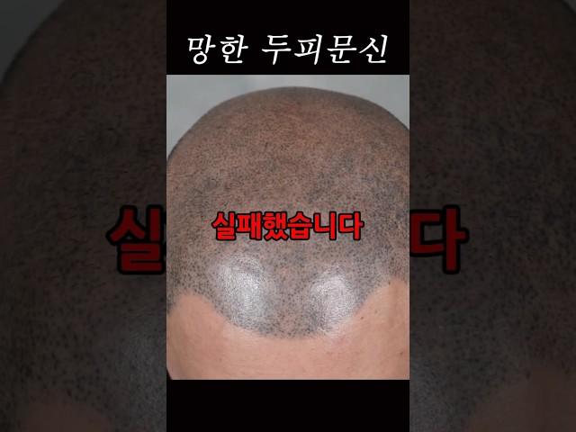 두피문신 부작용 이만큼 위험합니다