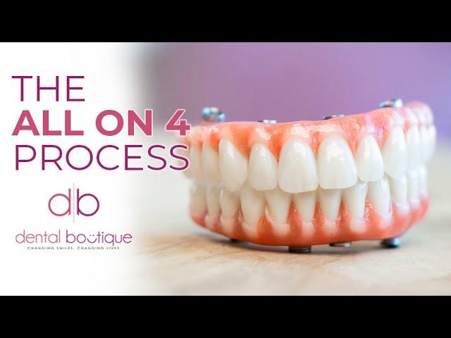 All on Implants The Process At Dental Boutique