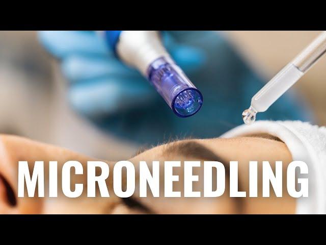 Microneedling for Acne Scars, Hyperpigmentation, Rosacea, Fine Lines + Wrinkles