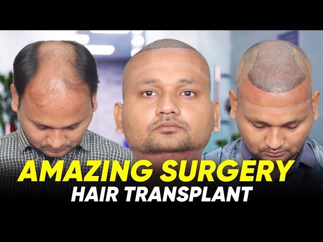 Hair Transplant in Surat | Best Results & Cost of Hair Transplant in Surat