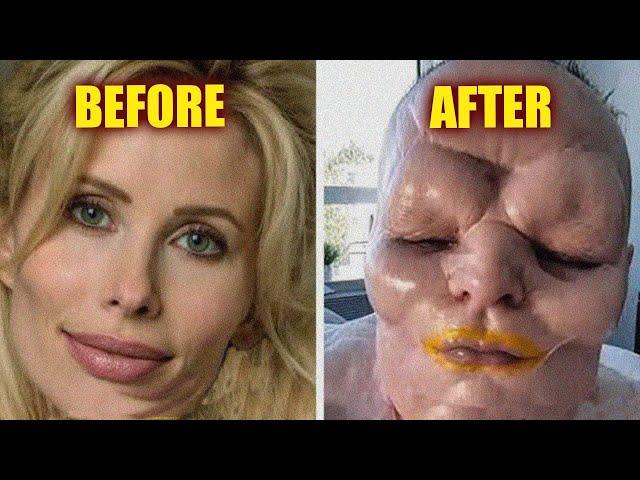 MUST WATCH!! See Celebrities With Biggest Plastic Surgery Disasters!