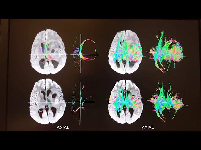 Society for Brain Mapping and Therapeutics (SBMT) - Nasser Kashou Research Overview