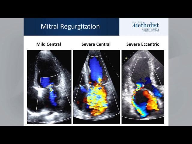 ASE Guidelines for Native Valvular Regurgitation Webinar