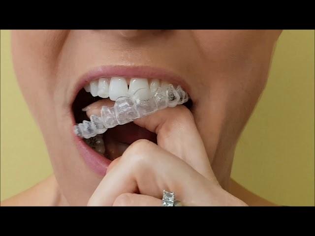 How to remove your Invisalign Aligners