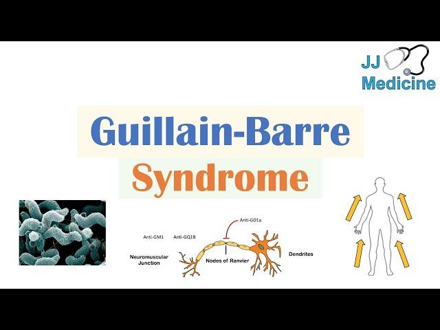 Guillain-Barré Syndrome (GBS) | Causes, Pathophysiology, Signs & Symptoms, Diagnosis, Treatment