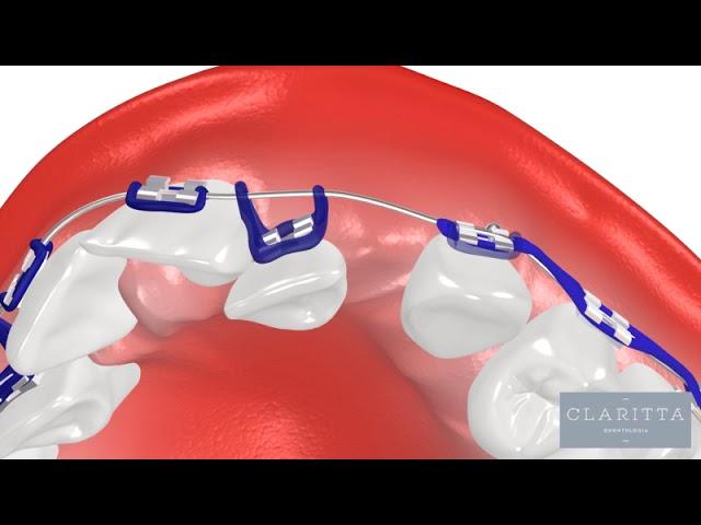 Oque é Ortodontia? Como funciona um Aparelho Ortodôntico? #ortodontia #invisalign #clinicajin