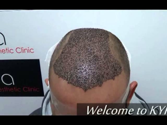 Best Hair Transplant Center in Ludhiana, Punjab - Kyra Clinic