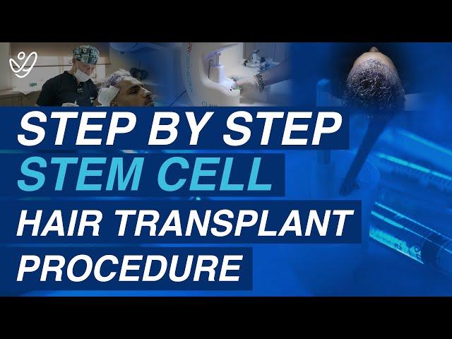 Transform Your Hair: Step-by-Step Stem Cell Hair Transplant