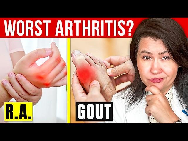 The 3 Most Severe Types of Arthritis Doctors Warn About!