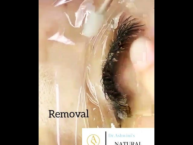 Eyelash Extensions Removal | Pune | Dr.Ashwinis Permanent Cosmetics | Natural Brows Academy