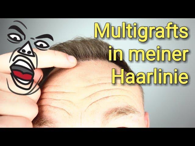 Multigrafts in meiner Haarlinie Haartransplantation /Haarausfall