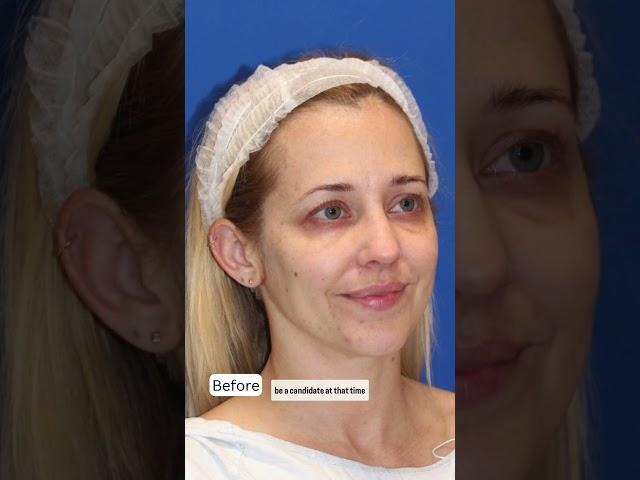 40 Year Old Woman Gets a Facelift...Her Results are STUNNING!