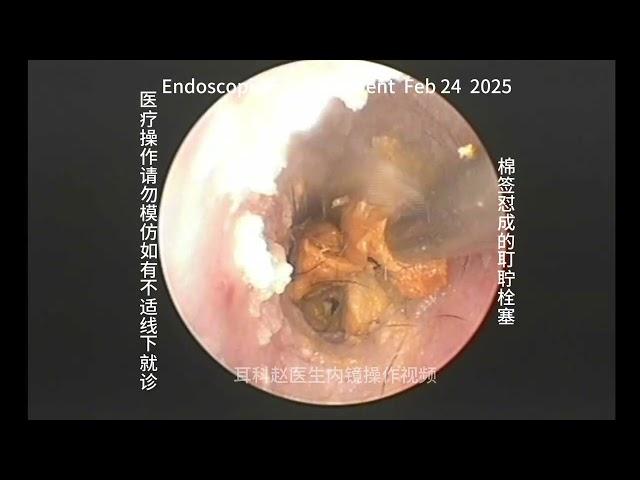 Cleaning cotton swabs can cause earwax embolism 20250224