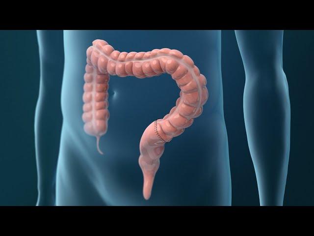 Treatments for Colorectal Cancer