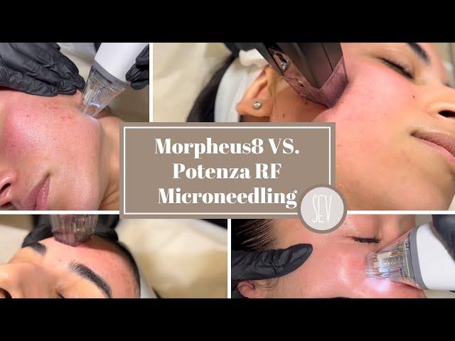 What is the Difference between Morpheus8 and Potenza RF Microneedling at SEV Laser