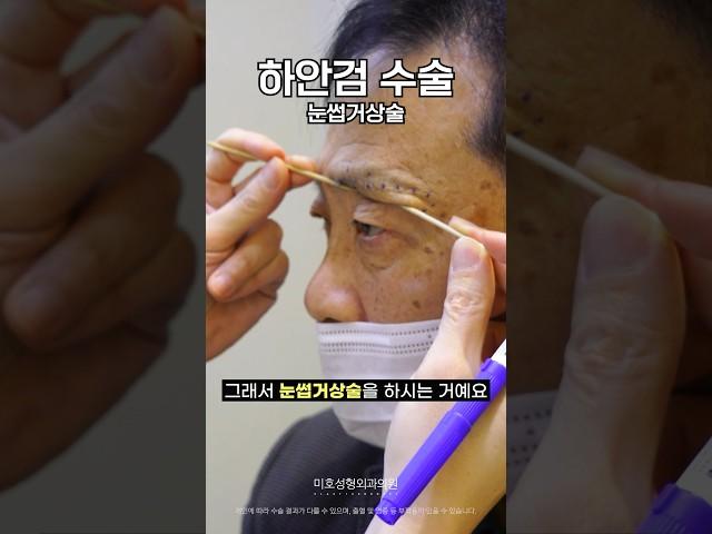 중년 눈성형  눈썹거상술 + 하안검 상담받고 수술한 1달차 후기 (미호 시그니처 눈밑성형)