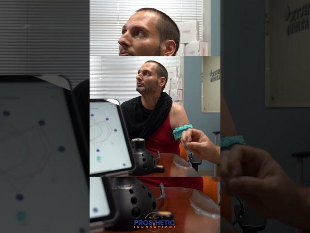 Pattern Recognition x TMR | Prosthetic Innovations  #prostheticinnovations #tmr