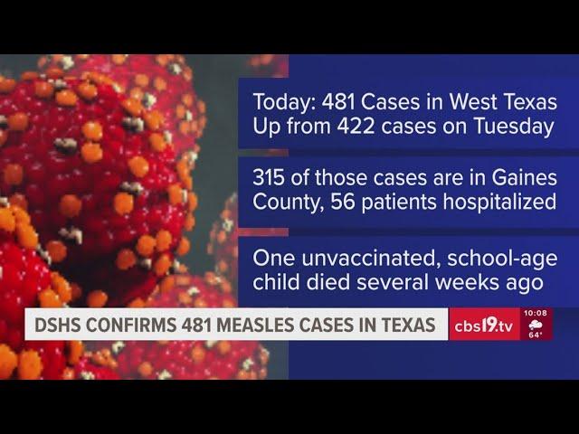 Nearly 500 cases of measles appear in Texas
