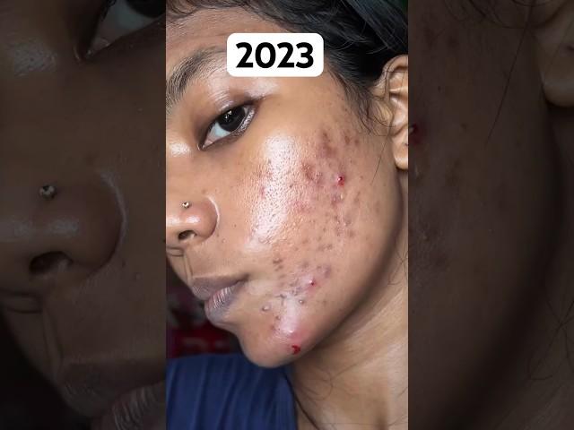 2023 to 2024 My acne treatment journey #shorts #skincare #acnetreatment #pimple #viral