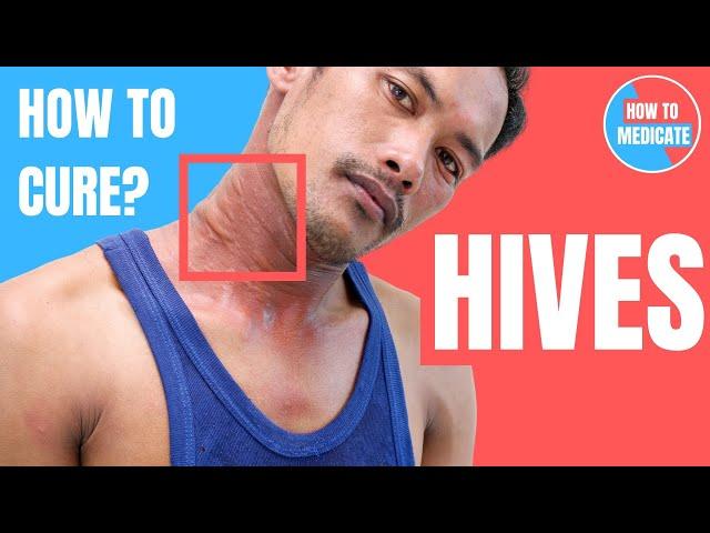 How to treat Hives (Urticaria)? - Doctor Explains