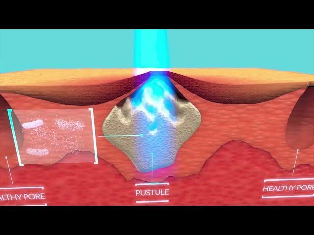 How Blue Light Therapy Works To Treat Acne