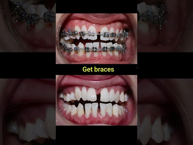 Braces evolution #braces #orthodontist #dentist #dental