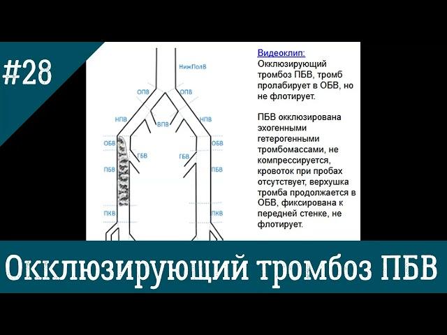 УЗИ вен. Окклюзирующий тромбоз ПБВ.