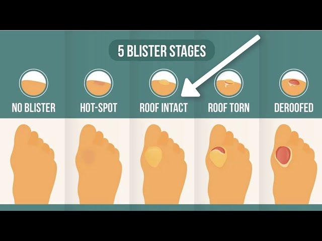 How To Treat A Blister Correctly (First, Look At Your Blister Roof)