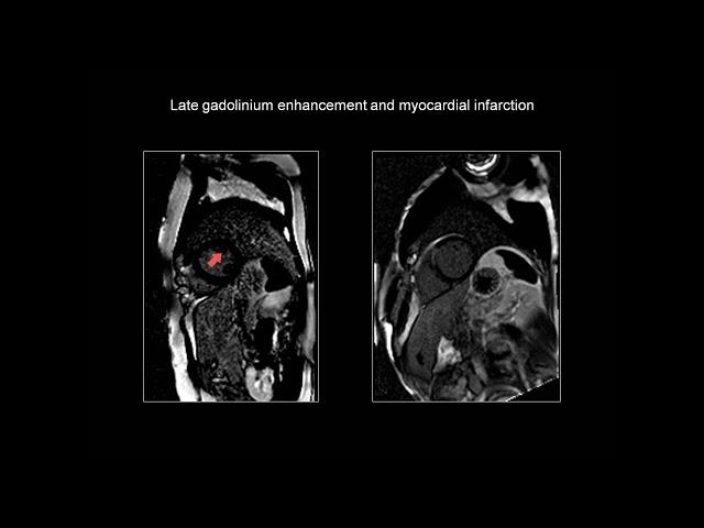 Cardiac Magnetic Resonance Imaging CMR in Myocardial Infarction