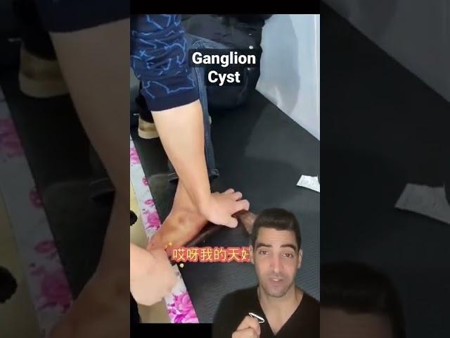 Ganglion Cyst