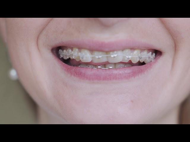 Benefits Of Ceramic Braces | Bellaviso Medical Center Dubai