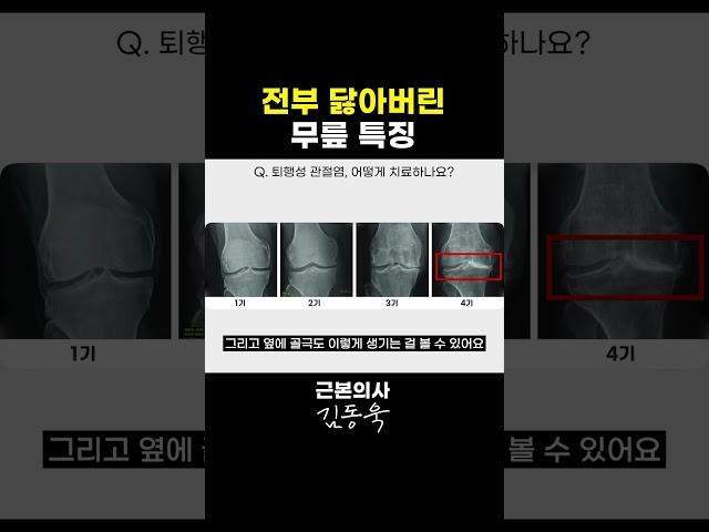 닳아없어진 무릎 특징 #무릎통증