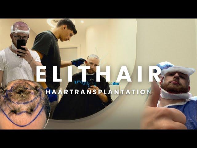 So läuft eine Haartransplantation ab bei Elithair.