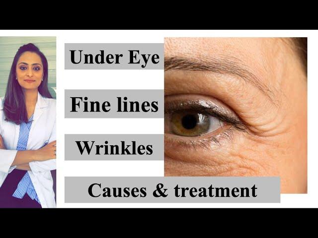 Fine lines | wrinkles| under eye|  causes & treatment| Prevention | Dr. Aanchal Panth