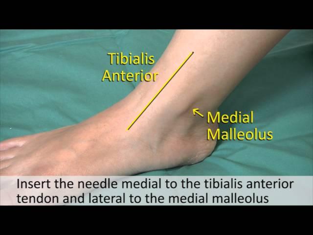 Musculoskeletal Examination and Joint Injection Series_ Ankle Joint Aspiration