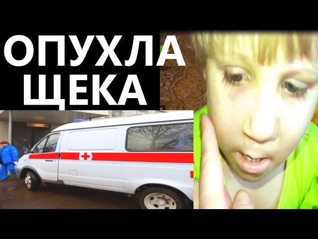 ОПУХЛА ЩЕКА у ребенка / провели целый день в БОЛЬНИЦЕ ВЛОГ