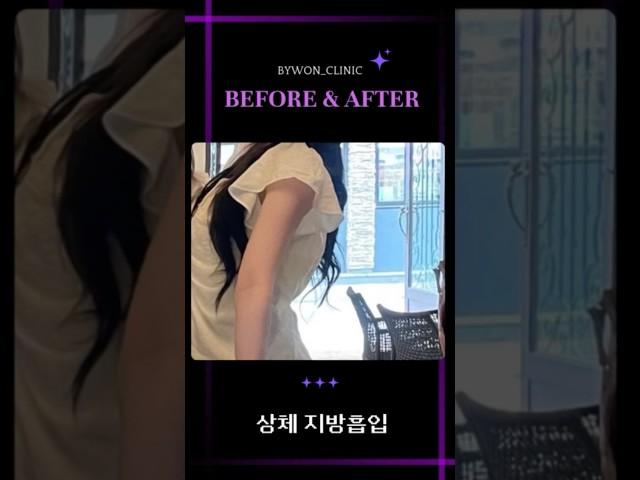 팔 지방흡입 후기 #지방흡입후기 #지방흡입
