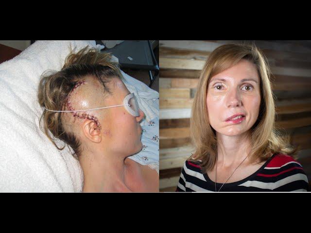 Brain Tumor Journey 2: From dizzy spells, headaches, vertigo, to diagnosis, Jodi Orgill Brown