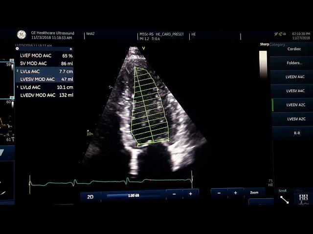 Ejection fraction measurement