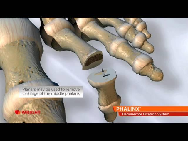 PHALINX™ Hammertoe Fixation System