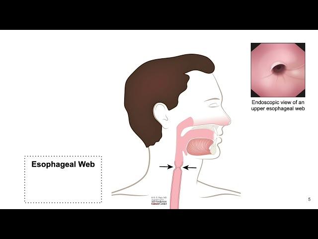 HCC 1475-2f3-Pathology of Esophagus-Esophageal Web