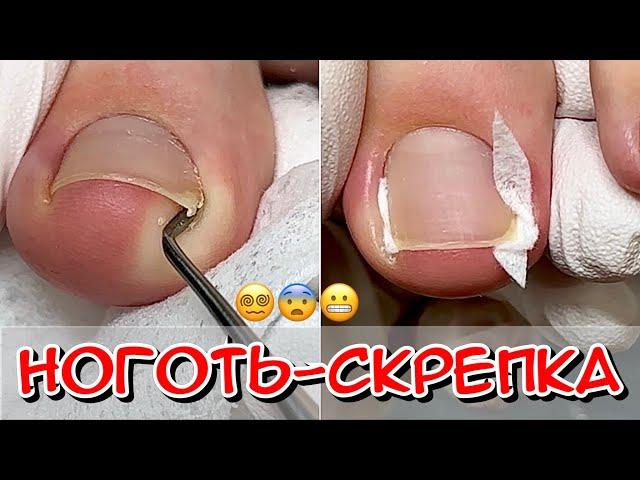 Nail - paperclip / Ingrown toenail / Ingrown toe / What to do / Ingrown toenail