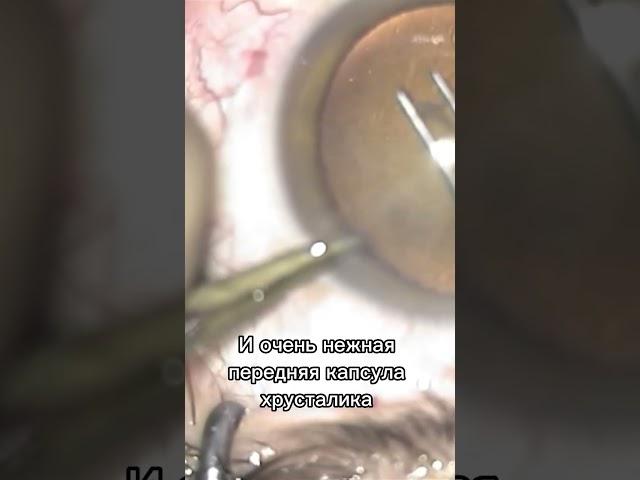 Удаление катаракты. Часть 3. Удаление передней капсулы хрусталика / Катаракта от А до Я